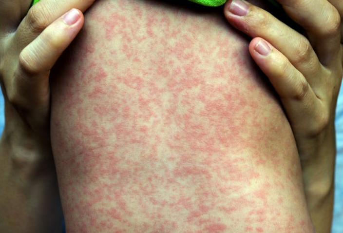 ХӨСҮТ: Улаанбурхан өвчний батлагдсан тохиолдол 7 нэмэгджээ